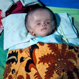 Bayi Penderita Hidrosefalus